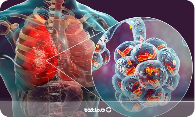 عفونت ریه چیست؟ انواع، علت و علائم + [بهترین قرص و شربت]