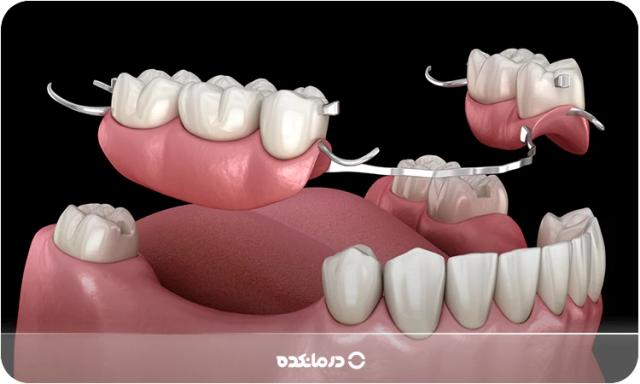 پروتز دندان [ثابت و متحرک] چیست؟ انواع + ۹ مزایا و عوارض