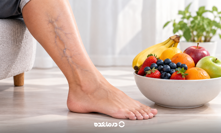 برای درمان واریس چه بخوریم؟ ۲۴ خوراکی مفید برای واریس پا + غذاهای مضر