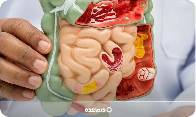 انسداد روده چیست و چرا ایجاد میشود؟ | علائم و روش تشخیص